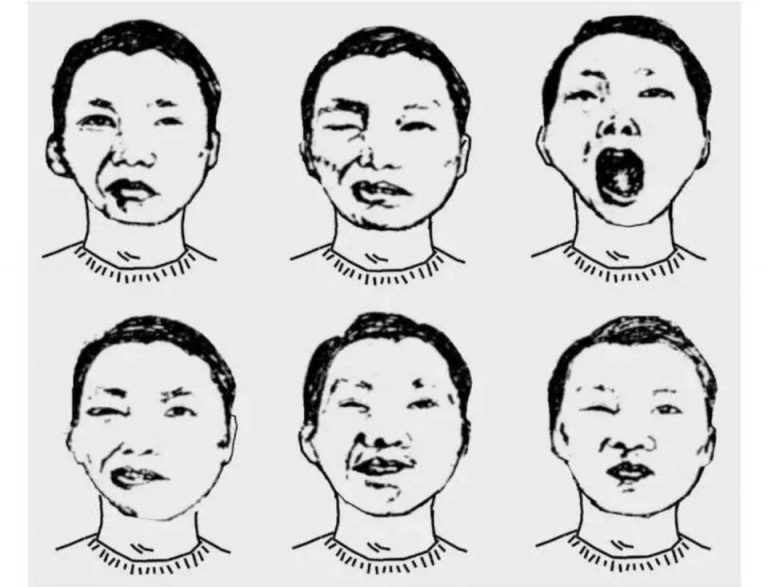 Bell’s Palsy Integrated Oriental Medicine